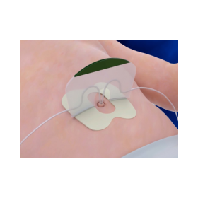 NeoBridge® Umbilical Catheter Holder