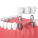 Impact TMA Internal Hex Dental Implant Abutment - Straight(Collar Height - 1mm)