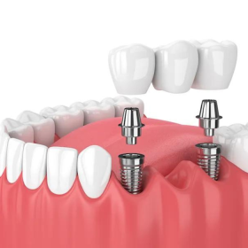 Impact TMA Internal Hex Dental Implant Abutment - Straight(Collar Height - 1mm)