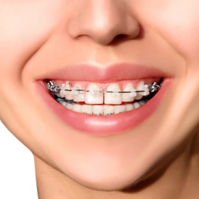 Metro Orthodontics Round Stainless Steel Archwires