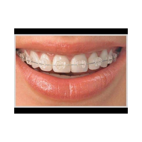 Metro Orthodontics Purple Series Pack of 20 Ceramic Conventional Brackets